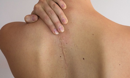 Cicatrices, algo más que un problema estético: ¿cómo podemos minimizarlas?