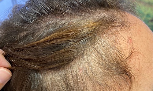 Alopecia con patrón femenino. Su importancia en medicina y cirugía estética