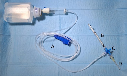 Circuito cerrado con llave de tres vías para la infiltración de anestesia y tumescencia en cirugía capilar