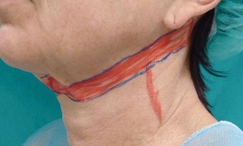 Técnicas para rejuvenecer el cuello mínimamente invasivas