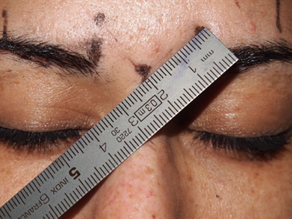 Marcación de los puntos de inyección con toxina botulínica en el tercio  superior de la cara