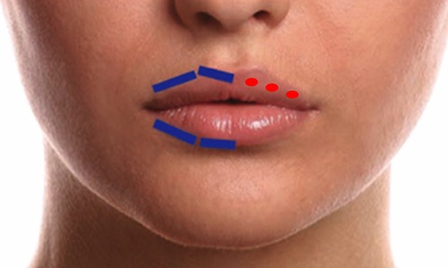 Técnicas de relleno facial con ácido hialurónico y neuromodulación para el rejuvenecimiento perioral. Revisión sistemática