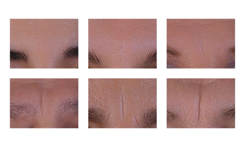 Efecto del tratamiento oral con glucosamina-hesperidina-manganeso en la profundidad de las arrugas y la calidad de la piel